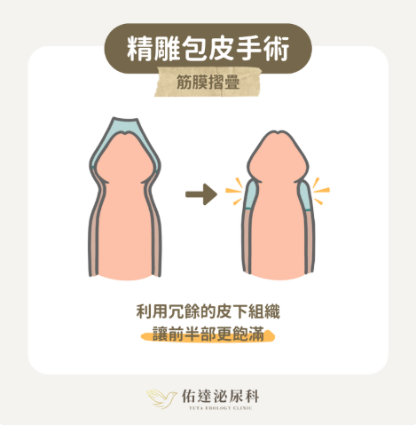 包皮槍手術後勃起疼痛與二次修整案例