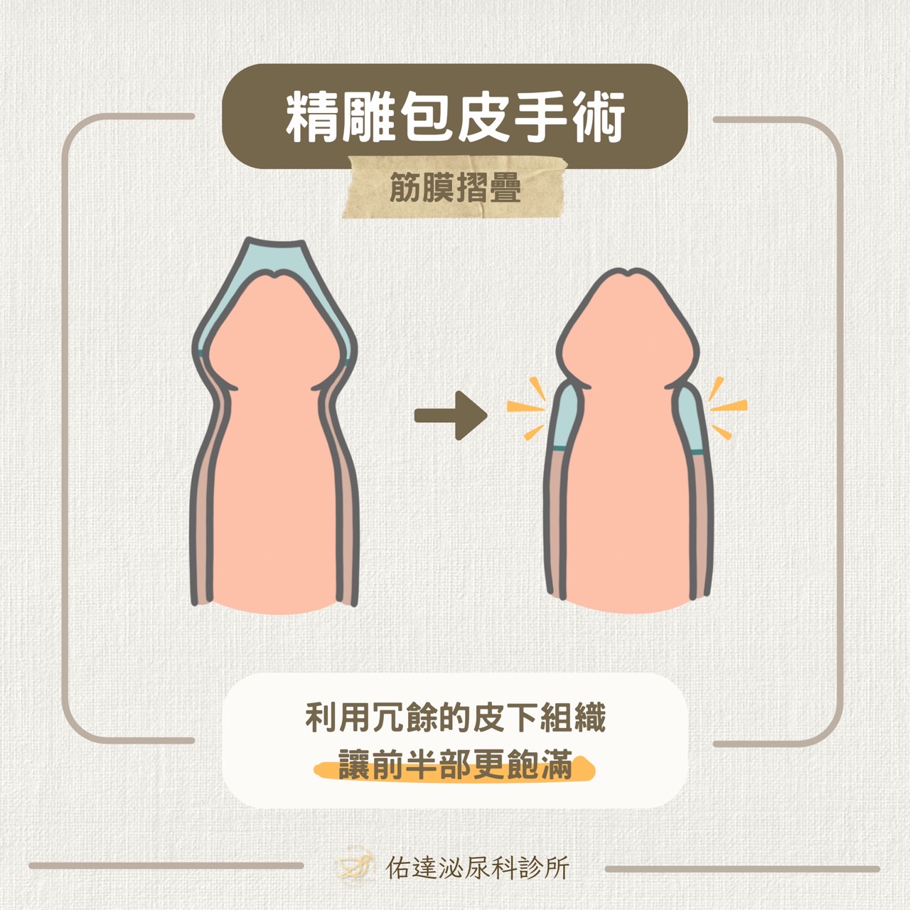 精雕包皮手術