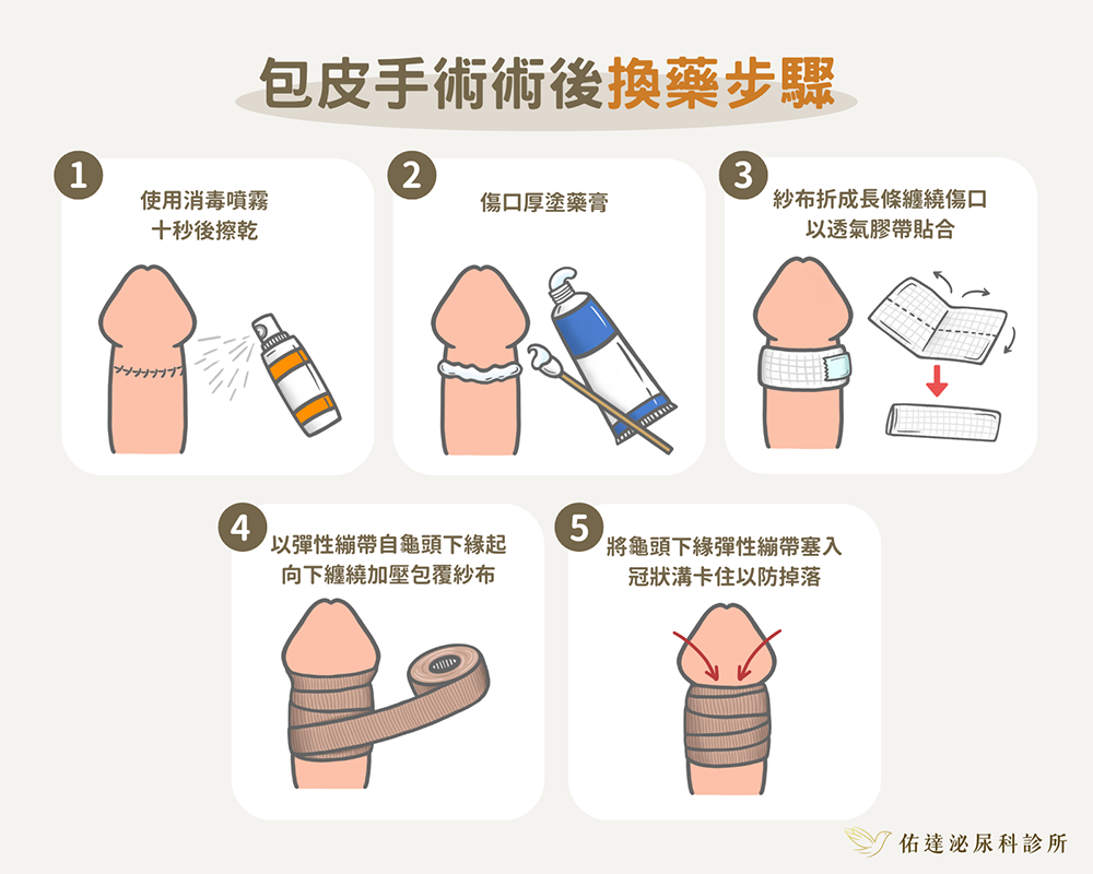 包皮手術文章圖片 12
