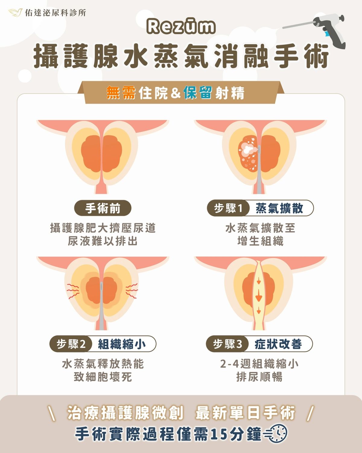 Rezum 攝護腺水蒸氣消融手術原理 - 手術前、蒸氣擴散、組織縮小、症狀改善 4 步驟圖解 - 佑達泌尿科